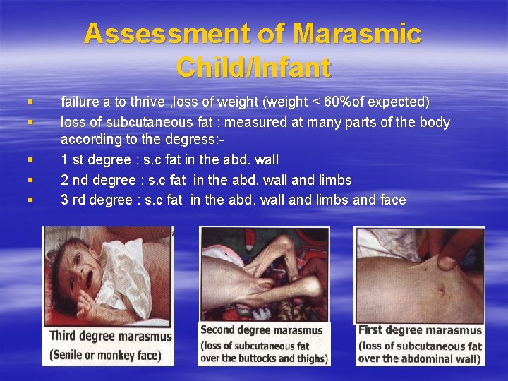 Assessment of Marasmic Child/Infant § § § failure a to thrive , loss of