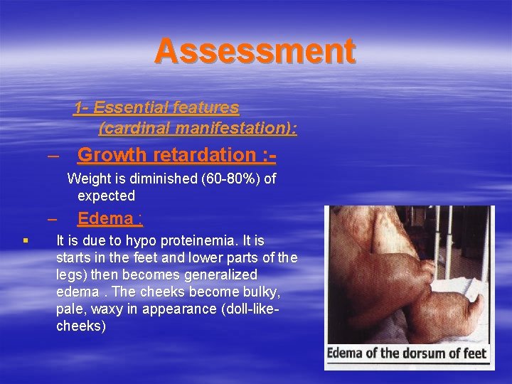 Assessment 1 - Essential features (cardinal manifestation): – Growth retardation : Weight is diminished