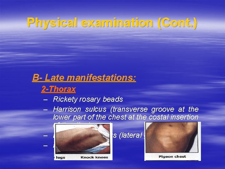 Physical examination (Cont. ) B- Late manifestations: 2 -Thorax – Rickety rosary beads –