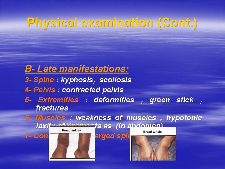Physical examination (Cont. ) B- Late manifestations: 3 - Spine : kyphosis, scoliosis 4