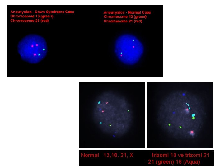 Normal 13, 18, 21, X trizomi 18 ve trizomi 21 21 (green) 18 (Aqua)