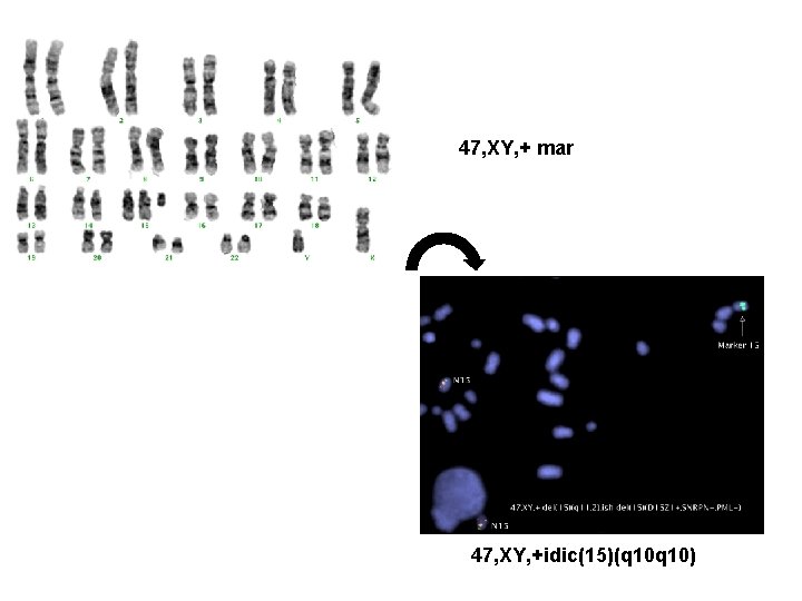 47, XY, + mar 47, XY, +idic(15)(q 10) 