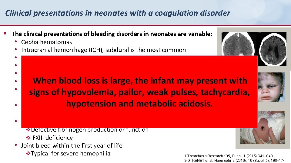Clinical presentations in neonates with a coagulation disorder § The clinical presentations of bleeding
