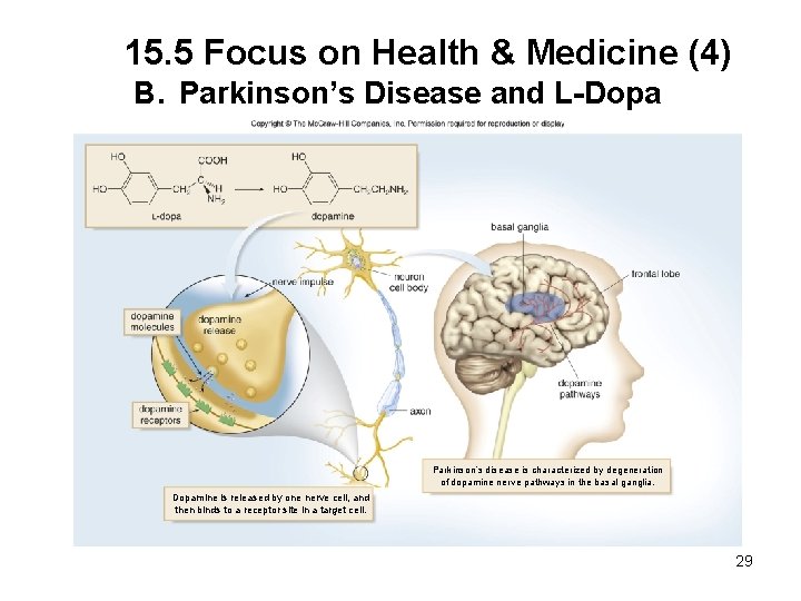 15. 5 Focus on Health & Medicine (4) B. Parkinson’s Disease and L-Dopa Parkinson’s