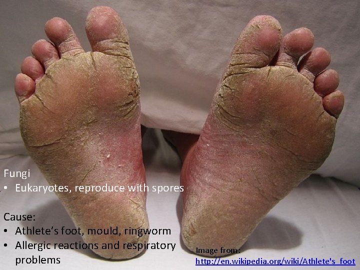 Fungi • Eukaryotes, reproduce with spores Cause: • Athlete’s foot, mould, ringworm • Allergic