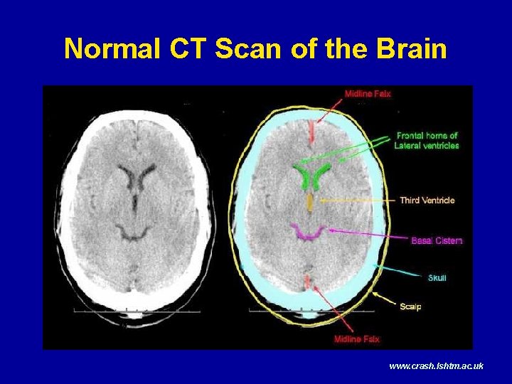 Normal CT Scan of the Brain www. crash. lshtm. ac. uk 