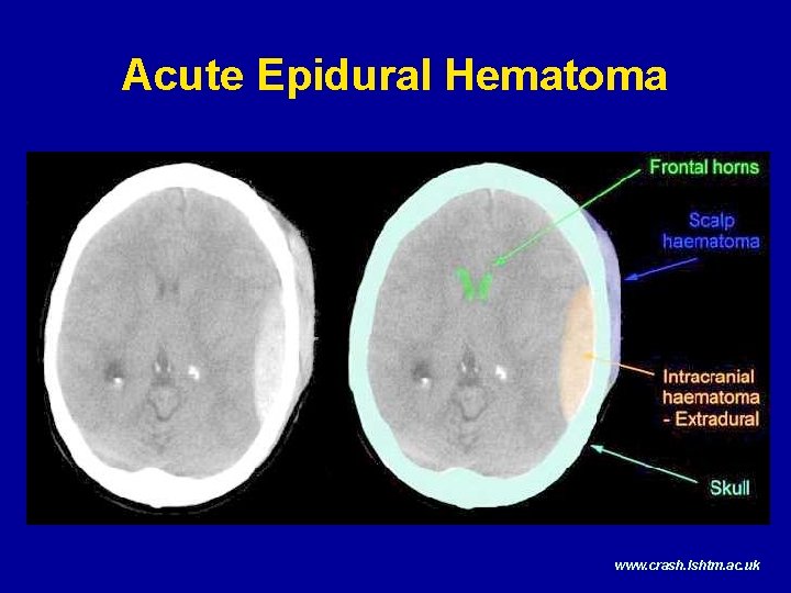 Acute Epidural Hematoma www. crash. lshtm. ac. uk 