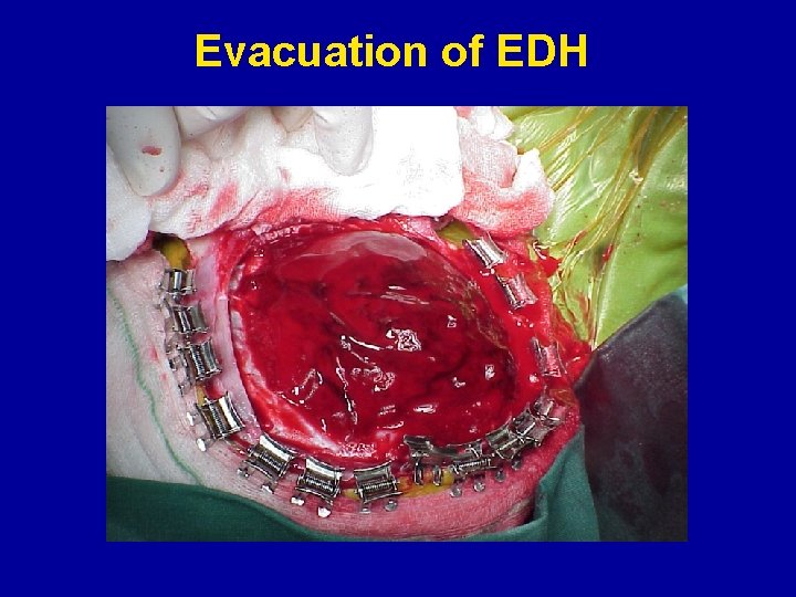 Evacuation of EDH 