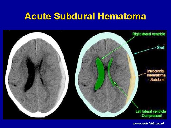 Acute Subdural Hematoma www. crash. lshtm. ac. uk 