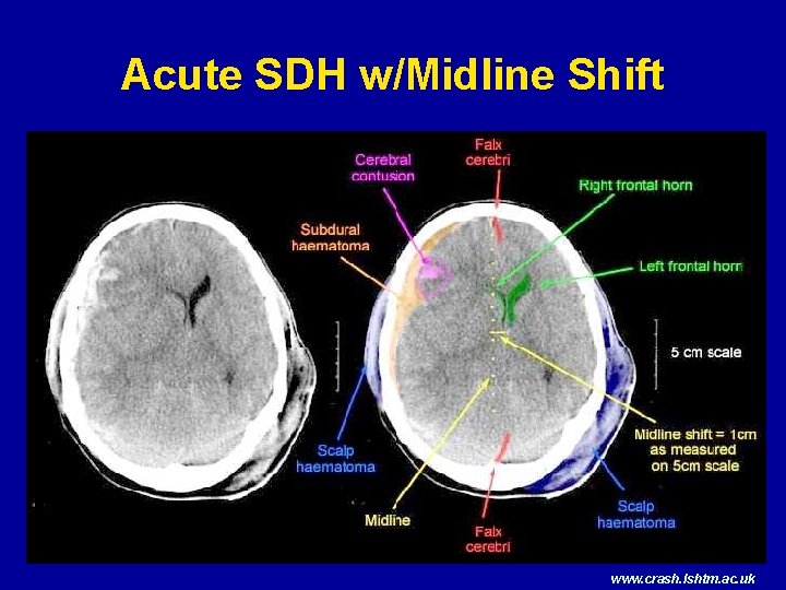 Acute SDH w/Midline Shift www. crash. lshtm. ac. uk 