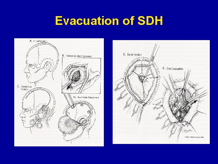 Evacuation of SDH 