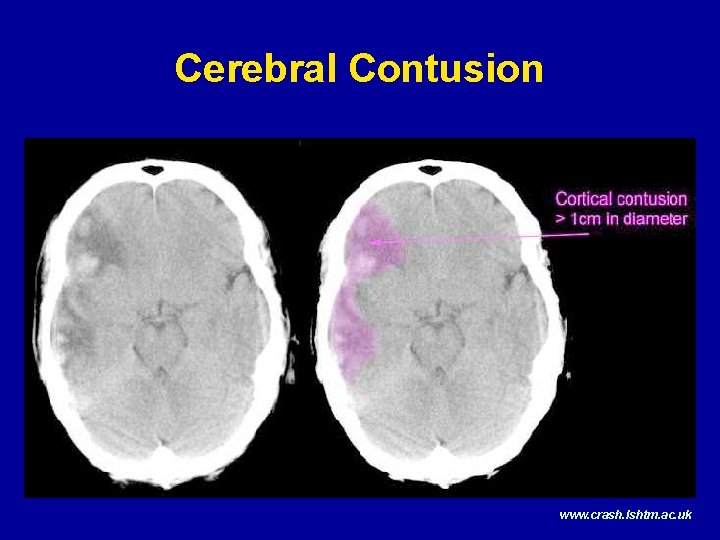 Cerebral Contusion www. crash. lshtm. ac. uk 