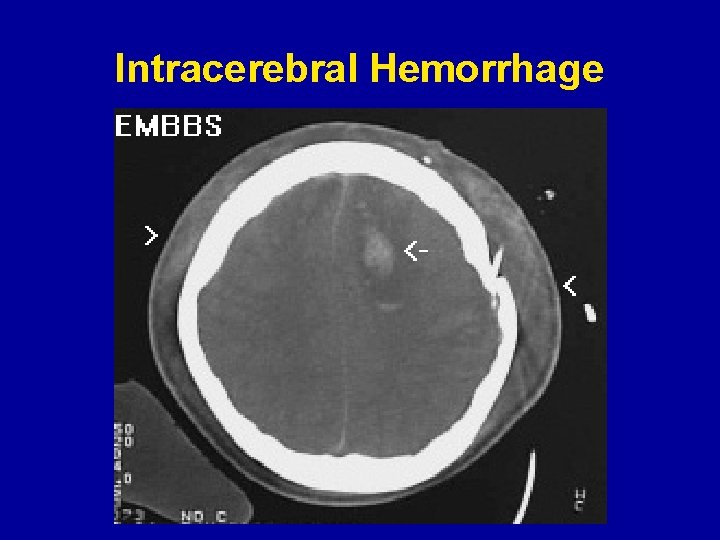 Intracerebral Hemorrhage 
