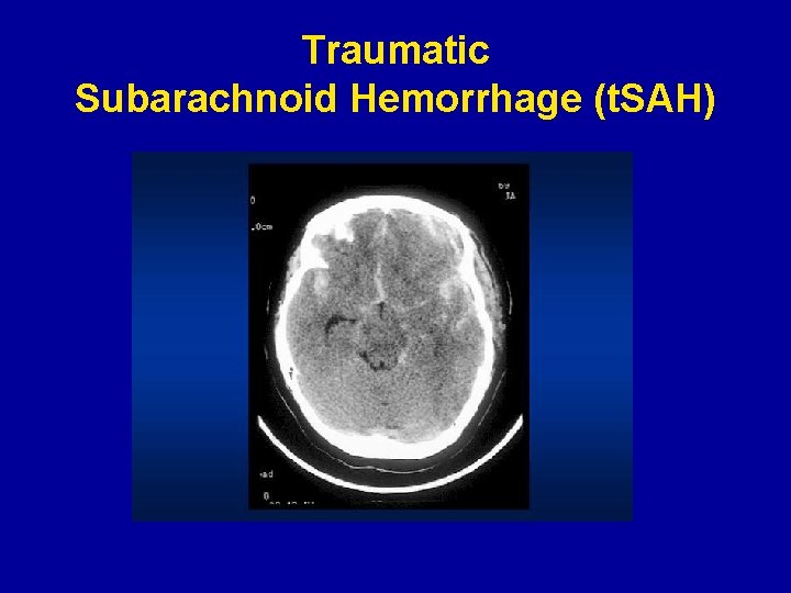 Traumatic Subarachnoid Hemorrhage (t. SAH) 