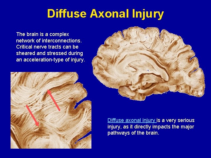 Diffuse Axonal Injury The brain is a complex network of interconnections. Critical nerve tracts