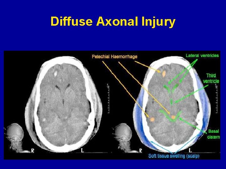 Diffuse Axonal Injury 