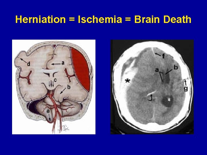 Herniation = Ischemia = Brain Death 