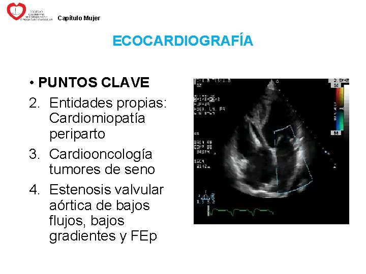 Capítulo Mujer ECOCARDIOGRAFÍA • PUNTOS CLAVE 2. Entidades propias: Cardiomiopatía periparto 3. Cardiooncología tumores