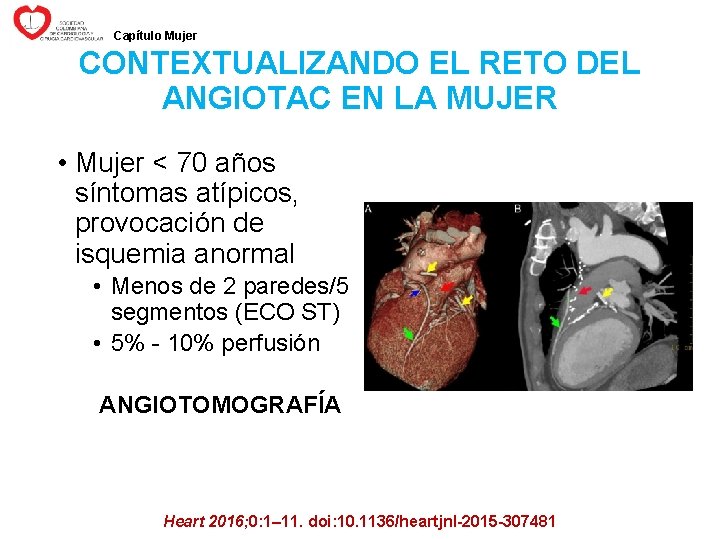 Capítulo Mujer CONTEXTUALIZANDO EL RETO DEL ANGIOTAC EN LA MUJER • Mujer < 70