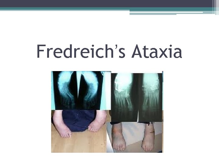 Fredreich’s Ataxia 