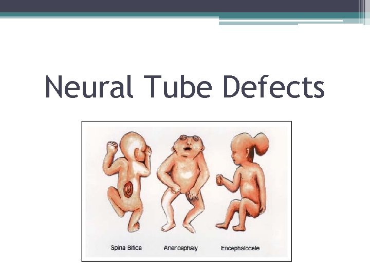 Neural Tube Defects 