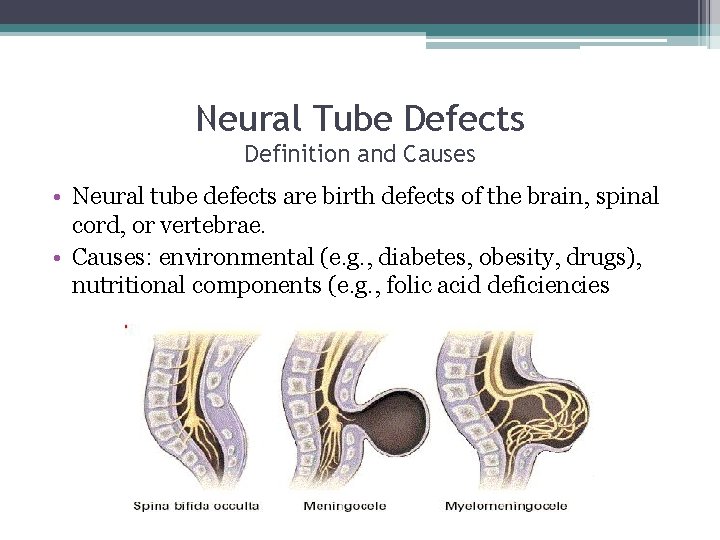 Neural Tube Defects Definition and Causes • Neural tube defects are birth defects of