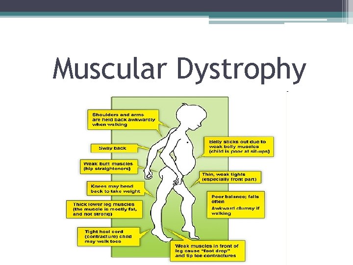 Muscular Dystrophy 