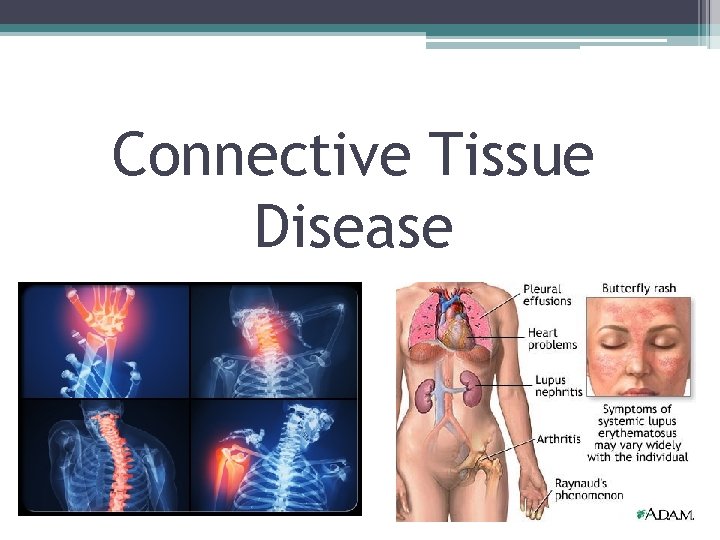 Connective Tissue Disease 