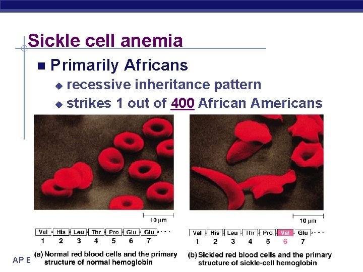 Sickle cell anemia n Primarily Africans recessive inheritance pattern u strikes 1 out of