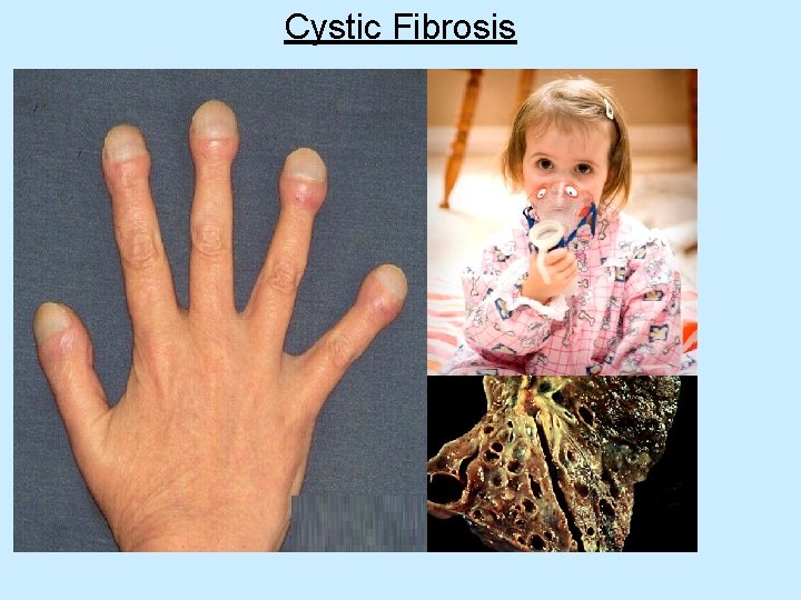 Cystic Fibrosis 