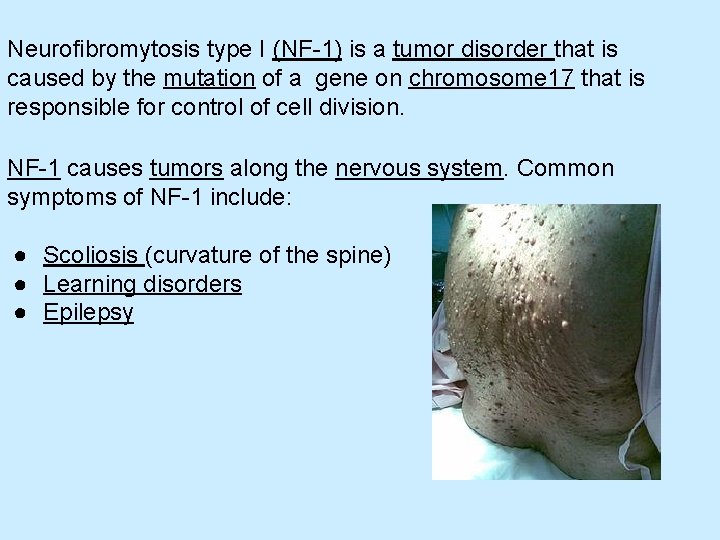 Neurofibromytosis type I (NF-1) is a tumor disorder that is caused by the mutation