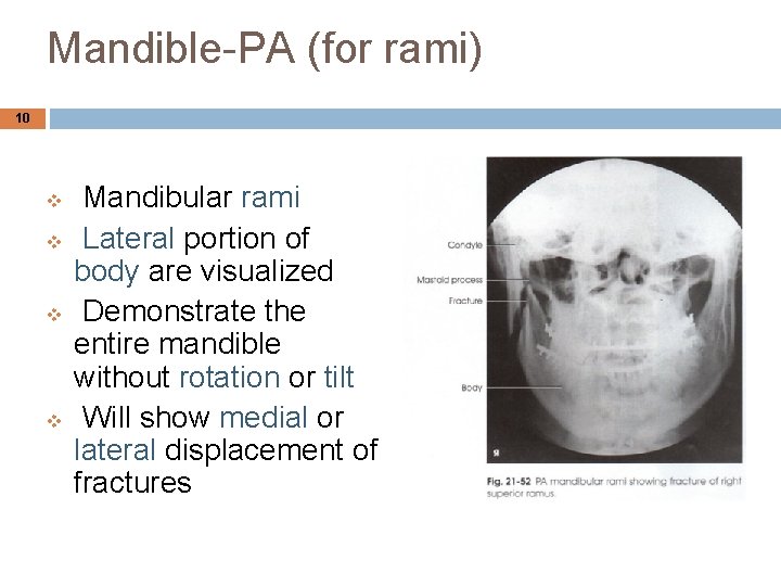 Mandible-PA (for rami) 10 v v Mandibular rami Lateral portion of body are visualized