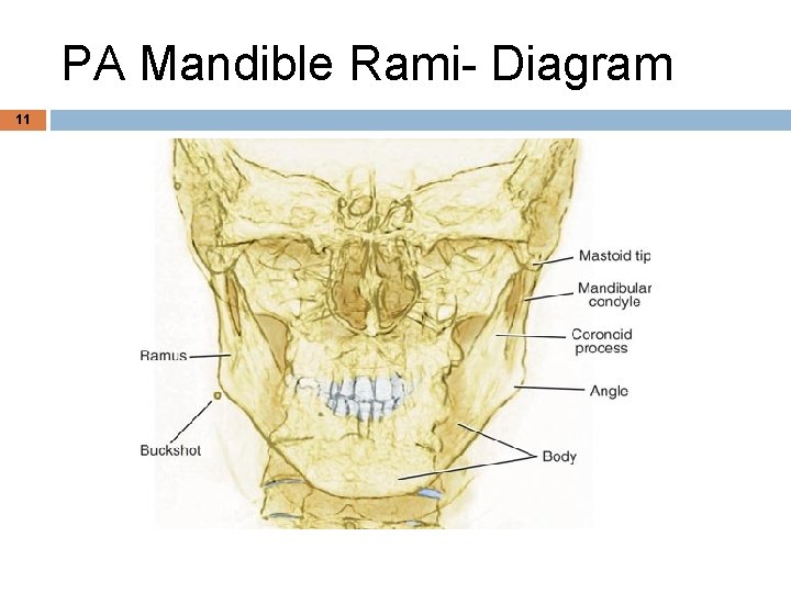 PA Mandible Rami- Diagram 11 