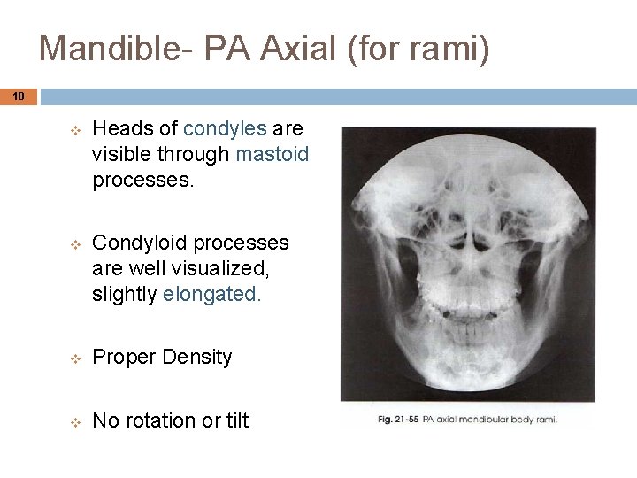 Mandible- PA Axial (for rami) 18 v v Heads of condyles are visible through