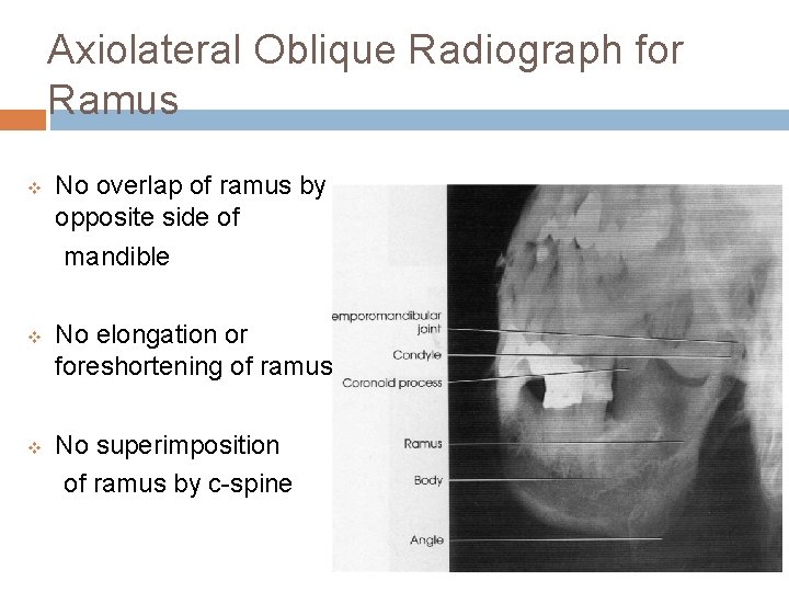 Axiolateral Oblique Radiograph for Ramus v v v No overlap of ramus by opposite