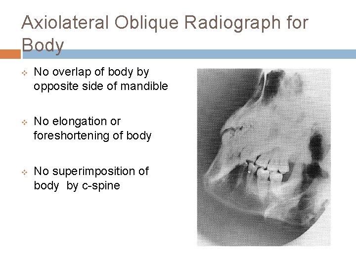 Axiolateral Oblique Radiograph for Body v v v No overlap of body by opposite