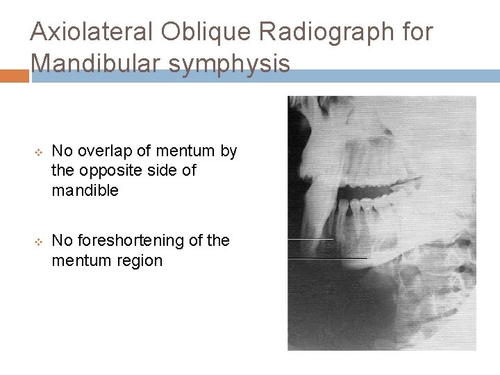 Axiolateral Oblique Radiograph for Mandibular symphysis v v No overlap of mentum by the