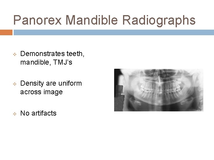Panorex Mandible Radiographs v v v Demonstrates teeth, mandible, TMJ’s Density are uniform across