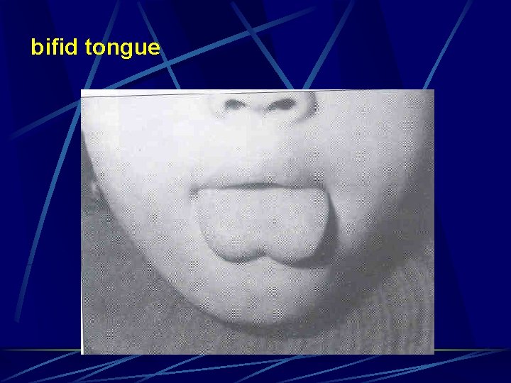 bifid tongue 