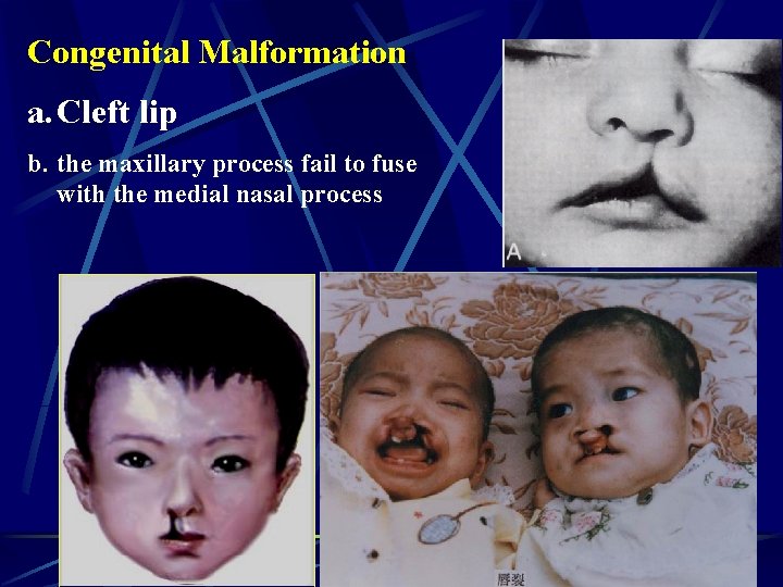 Congenital Malformation a. Cleft lip b. the maxillary process fail to fuse with the