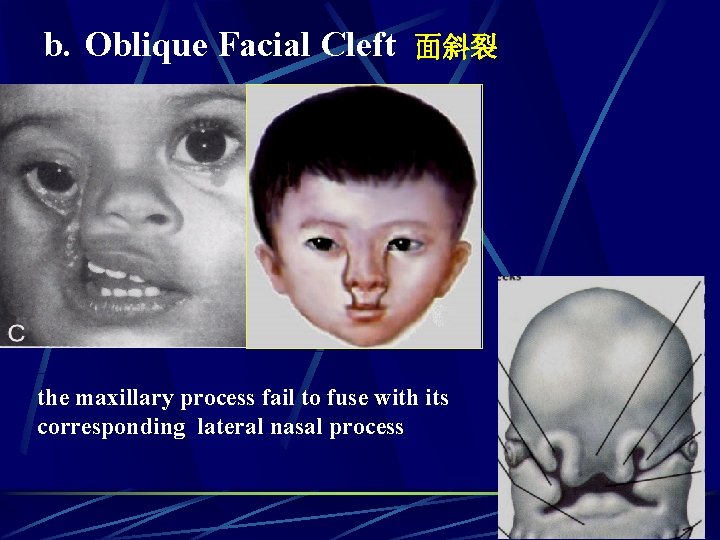 b. Oblique Facial Cleft 面斜裂 the maxillary process fail to fuse with its corresponding