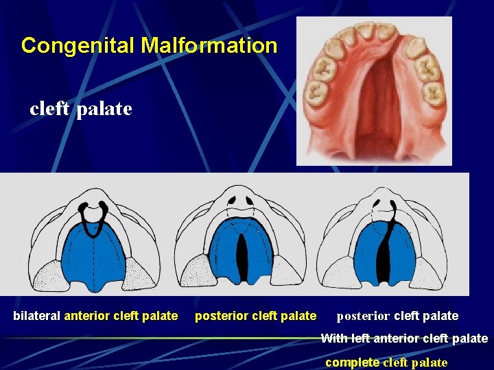 Congenital Malformation cleft palate bilateral anterior cleft palate posterior cleft palate With left anterior