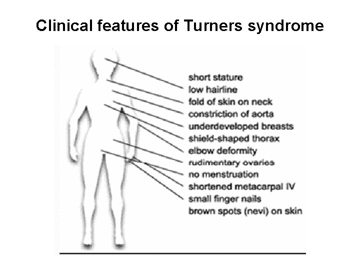 Clinical features of Turners syndrome 