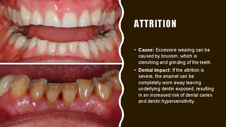 ATTRITION • Cause: Excessive wearing can be caused by bruxism, which is clenching and