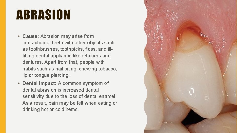 ABRASION • Cause: Abrasion may arise from interaction of teeth with other objects such