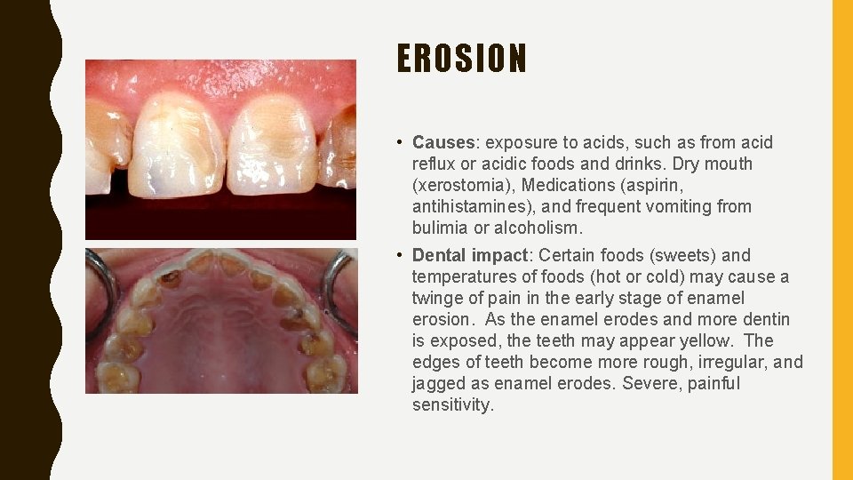 EROSION • Causes: exposure to acids, such as from acid reflux or acidic foods