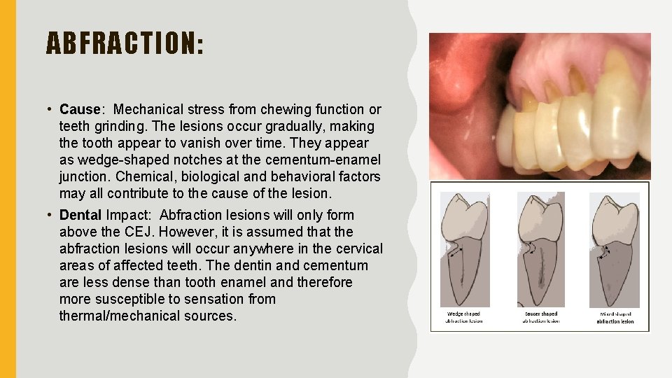 ABFRACTION: • Cause: Mechanical stress from chewing function or teeth grinding. The lesions occur