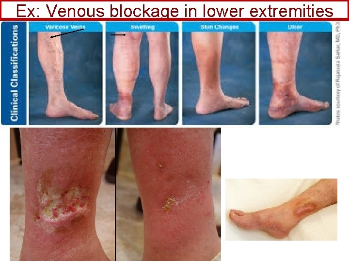 Ex: Venous blockage in lower extremities 