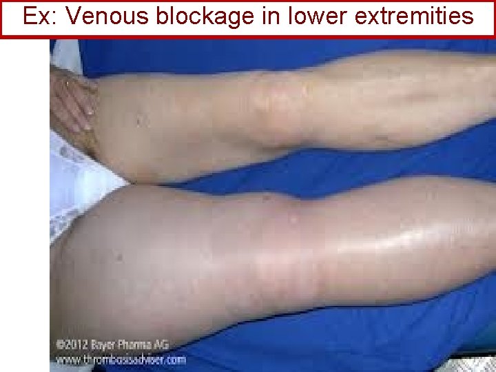 Ex: Venous blockage in lower extremities 