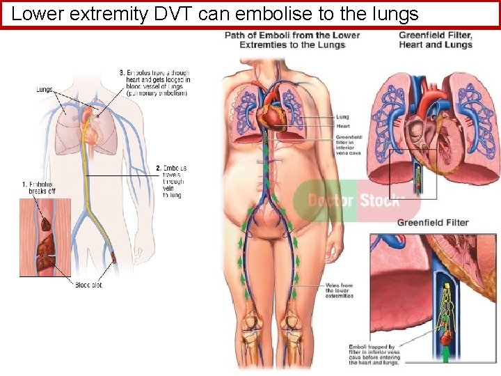 Lower extremity DVT can embolise to the lungs 